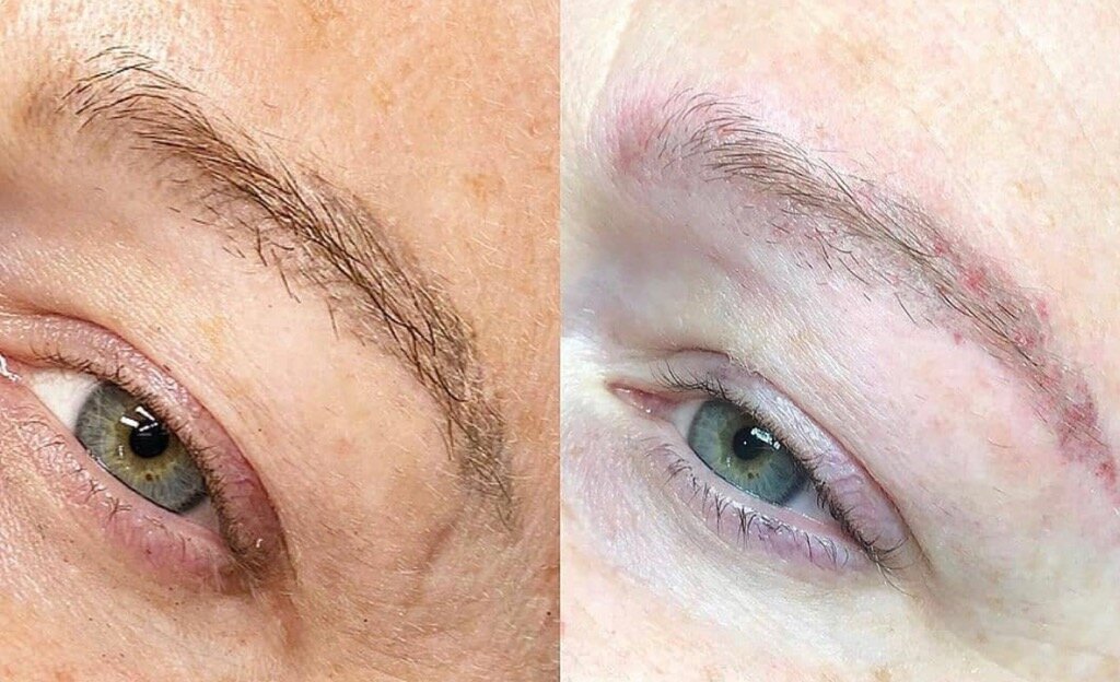 Saline Brow Tattoo Lightening